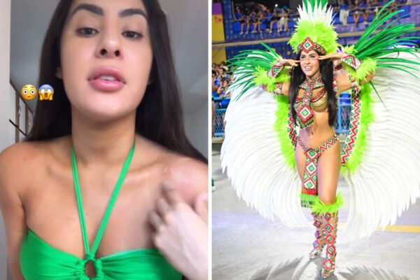 Isabelle Nogueira Revela Feridas do Carnaval: ‘Resultado de uma Guerra!’